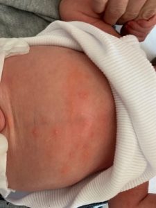 Newborn Rash Erythema Toxicum