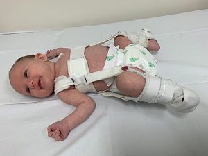 hip displacement in babies