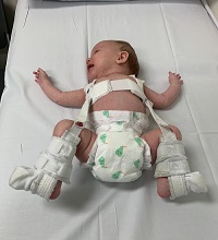 Pavlik Harness for Hip Dysplasia